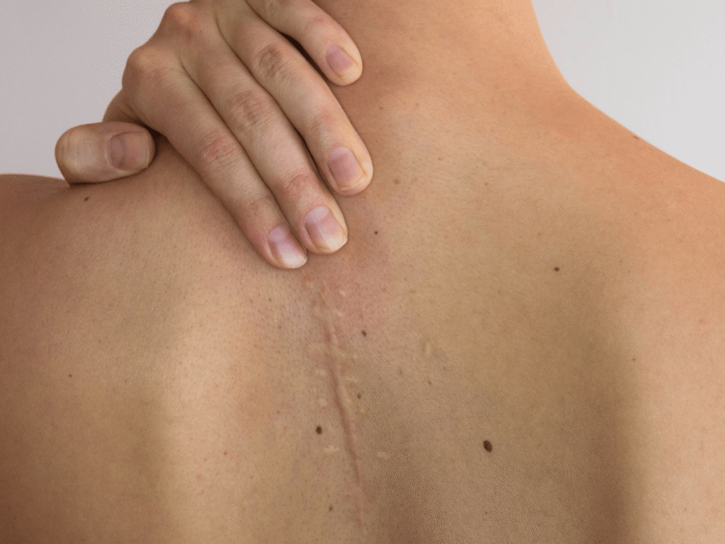 Person with their hand placed above scar on their upper back.